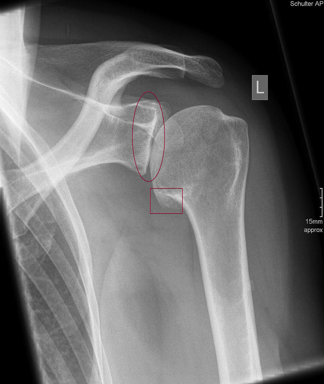 Röntgenbild Schulter ap einer initialen Omarthrose mit Ausbildung eines Teardrop-Osteophyts