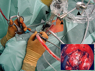 Mediastinoskopie: Endoskopisches minimal invasives Operationsverfahren in der Lungenchirurgie